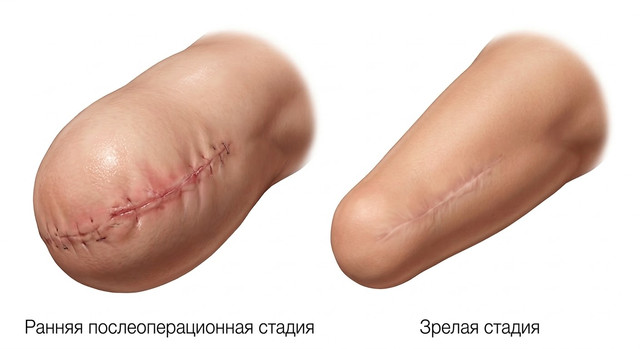 Формирование культи конечности: 5 критических ошибок в домашнем уходе, которые мешают протезированию